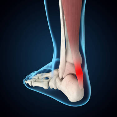 achilles tendon with tendonitis
