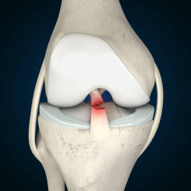 knee ligaments and acl rupture